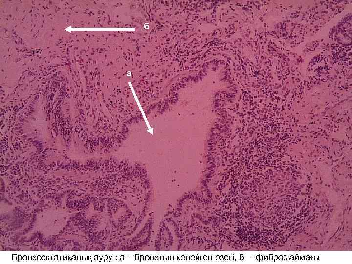 б а Бронхоэктатикалық ауру : а – бронхтың кеңейген өзегі, б – фиброз аймағы
