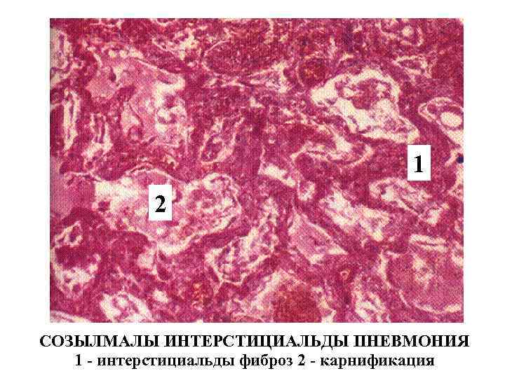 1 2 СОЗЫЛМАЛЫ ИНТЕРСТИЦИАЛЬДЫ ПНЕВМОНИЯ 1 - интерстициальды фиброз 2 - карнификация 