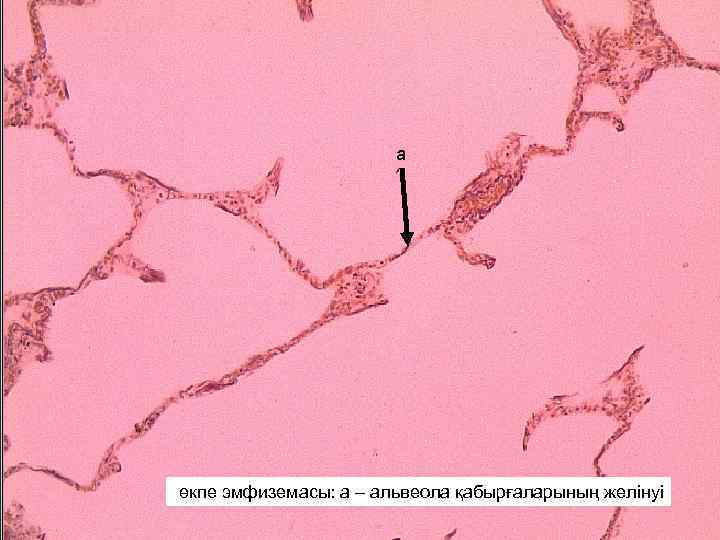 а өкпе эмфиземасы: а – альвеола қабырғаларының желінуі 