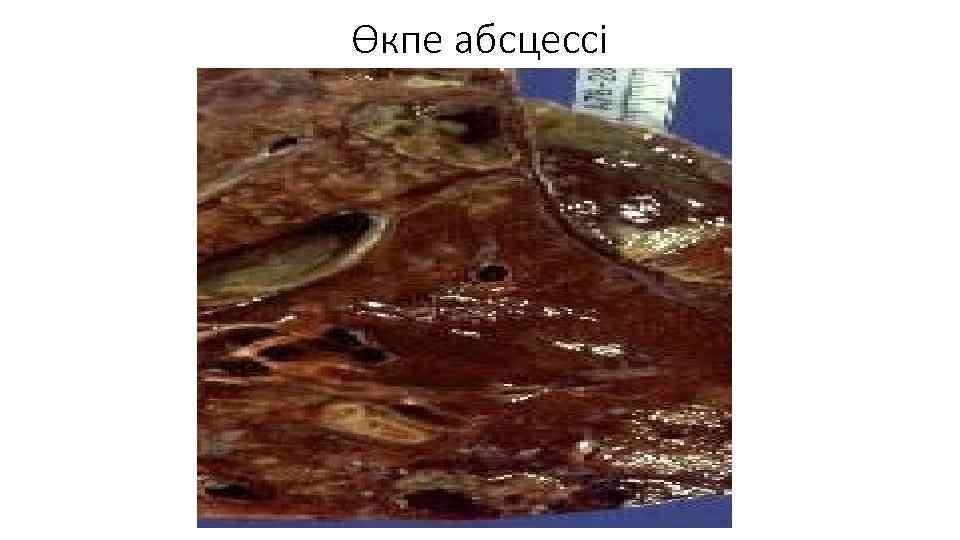 Өкпе абсцессі 