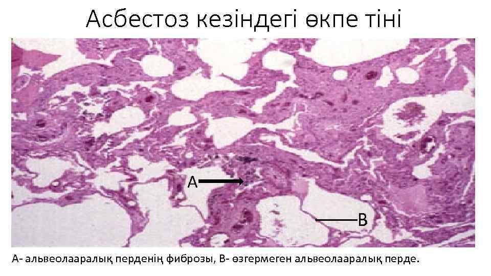 Асбестоз кезіндегі өкпе тіні А В А- альвеолааралық перденің фиброзы, В- өзгермеген альвеолааралық перде.