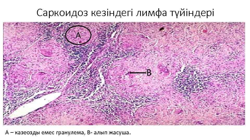 Саркоидоз кезіндегі лимфа түйіндері А В А – казеозды емес гранулема, В- алып жасуша.