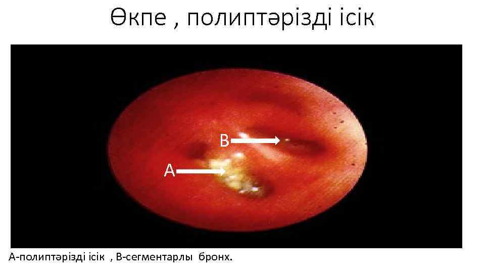 Өкпе , полиптәрізді ісік В А А-полиптәрізді ісік , В-сегментарлы бронх. 