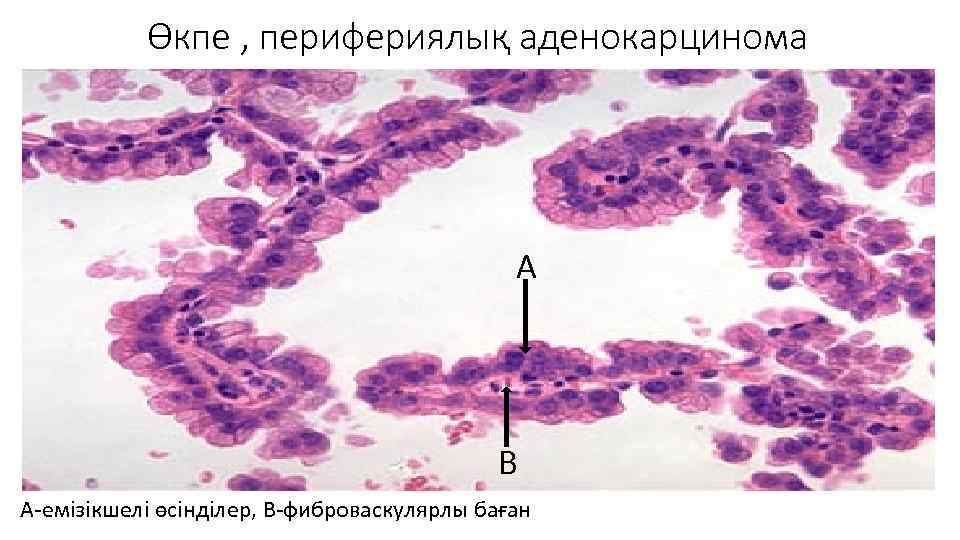 Өкпе , перифериялық аденокарцинома А В А-емізікшелі өсінділер, В-фиброваскулярлы баған 