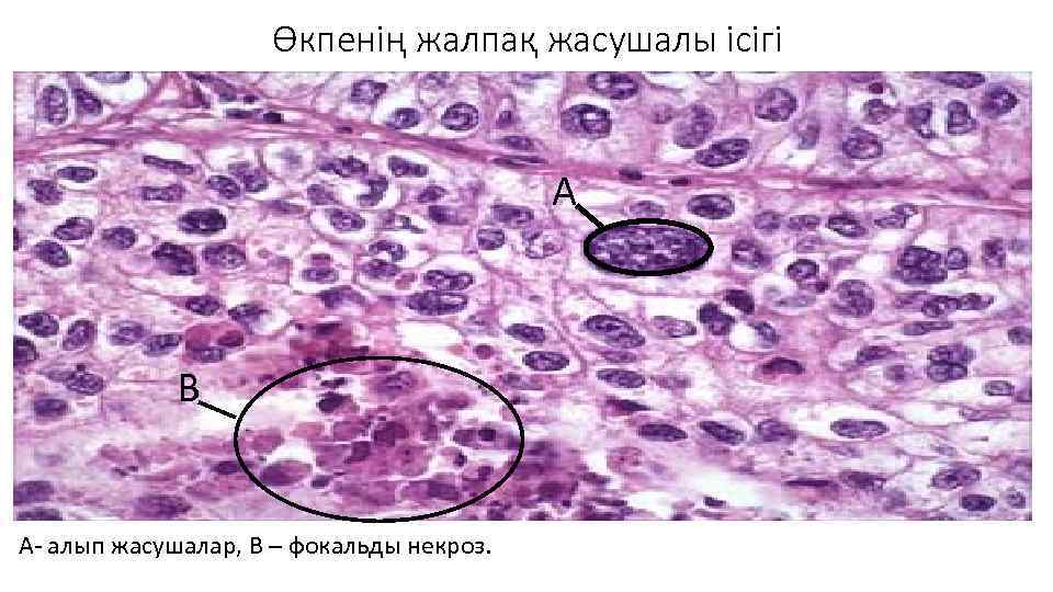 Өкпенің жалпақ жасушалы ісігі А В А- алып жасушалар, В – фокальды некроз. 