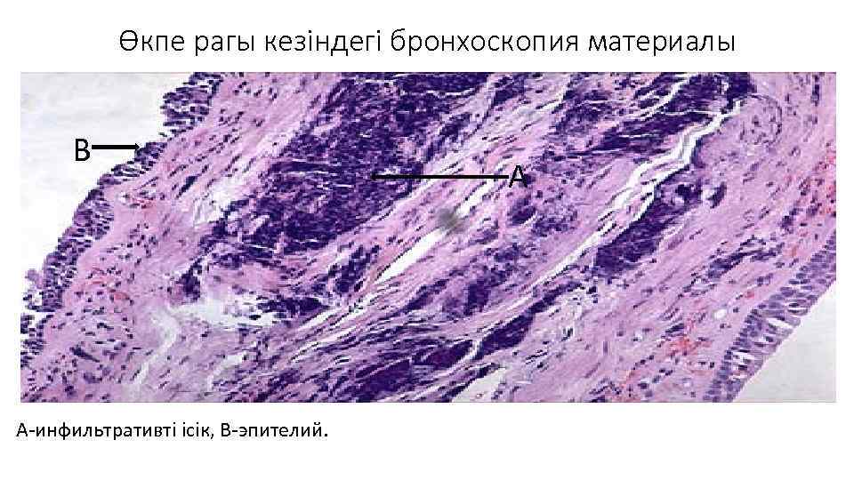 Өкпе рагы кезіндегі бронхоскопия материалы В А-инфильтративті ісік, В-эпителий. А 