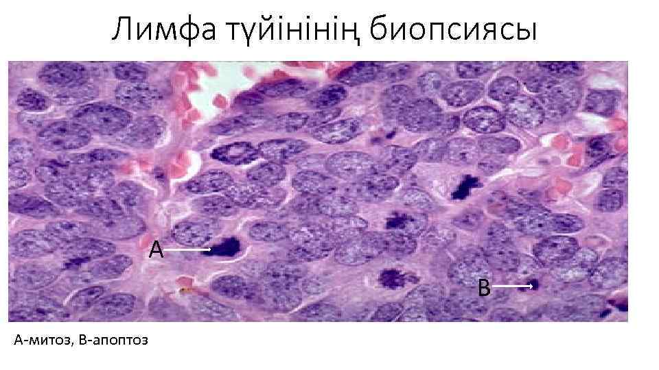 Лимфа түйінінің биопсиясы А В А-митоз, В-апоптоз 