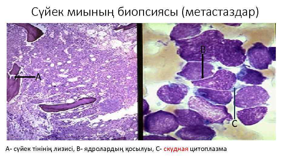 Сүйек миының биопсиясы (метастаздар) В А С А- сүйек тінінің лизисі, В- ядролардың қосылуы,