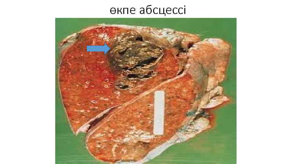 өкпе абсцессі 