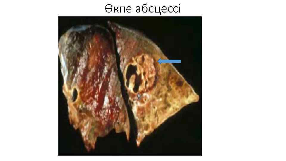 Өкпе абсцессі 