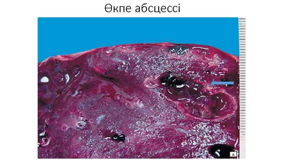 Өкпе абсцессі 