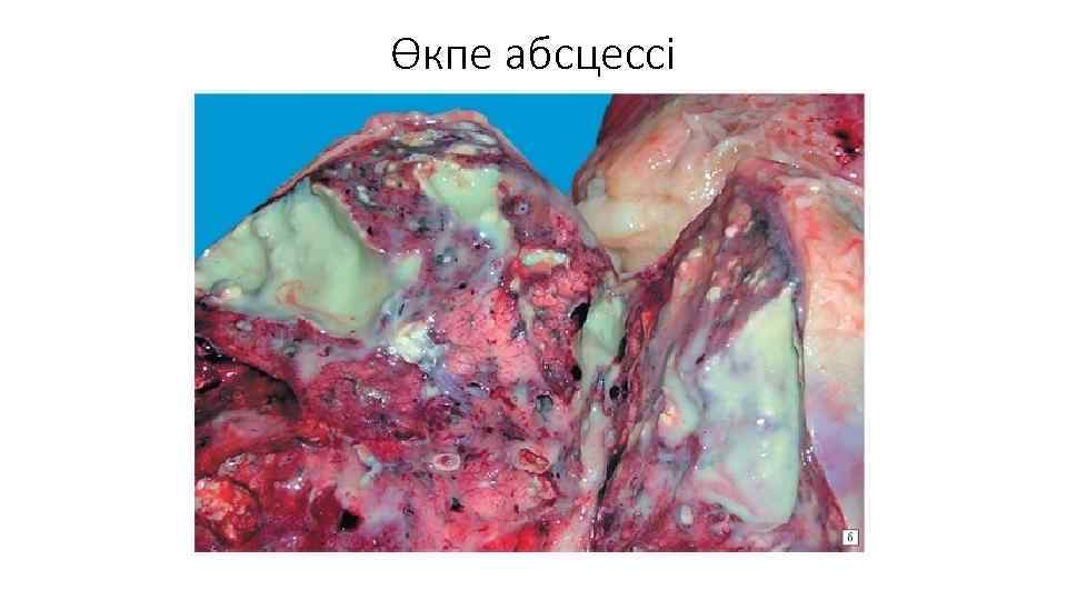 Өкпе абсцессі 