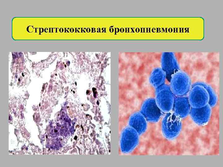 Стрептококковая бронхопневмония 