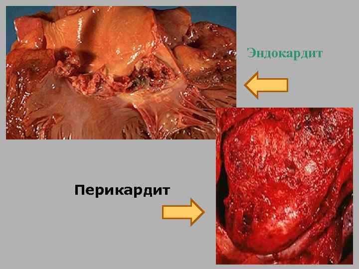 Эндокардит Перикардит 