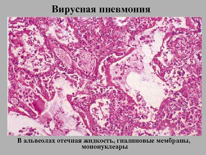 Вирусная пневмония В альвеолах отечная жидкость, гиалиновые мембраны, мононуклеары 