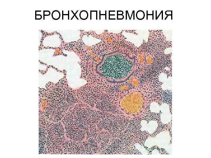 БРОНХОПНЕВМОНИЯ 