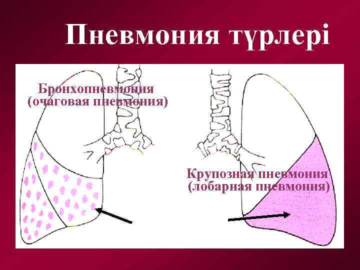 Пневмония түрлері Бронхопневмония (очаговая пневмония) Крупозная пневмония (лобарная пневмония) 