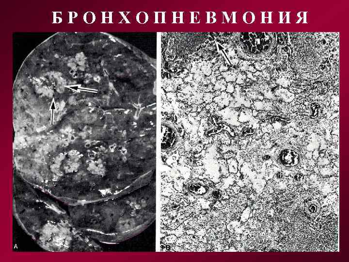 БРОНХОПНЕВМОНИЯ 