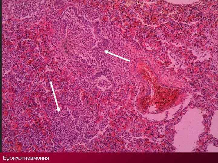 Бронхопневмония 