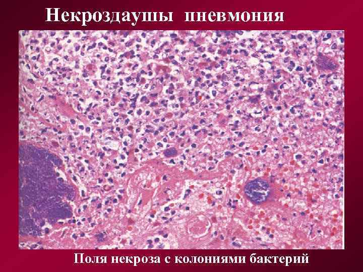 Некроздаушы пневмония Поля некроза с колониями бактерий 