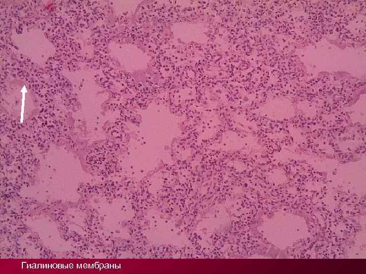 Гиалиновые мембраны 
