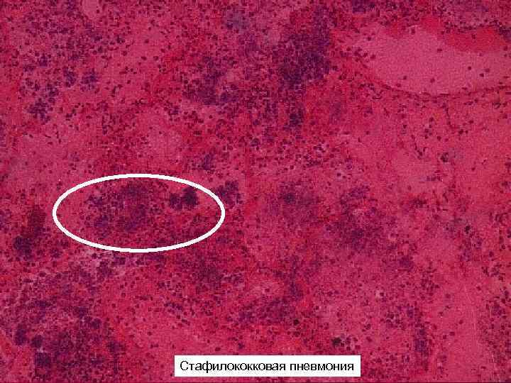 Стафилококковая пневмония 