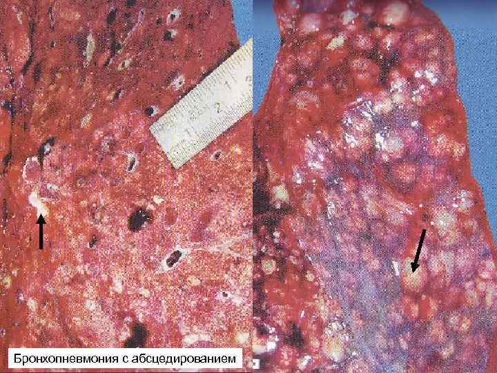 Бронхопневмония с абсцедированием 