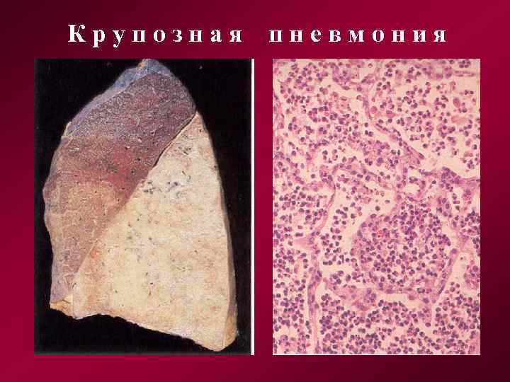 Крупозная пневмония 