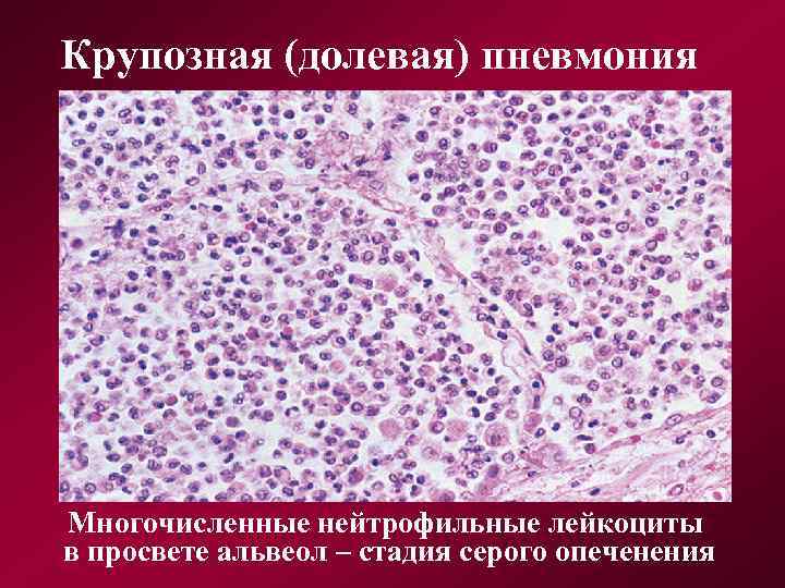 Крупозная (долевая) пневмония Многочисленные нейтрофильные лейкоциты в просвете альвеол – стадия серого опеченения 