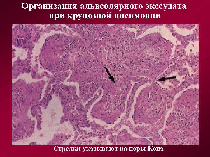 Организация альвеолярного экссудата при крупозной пневмонии Стрелки указывают на поры Кона 