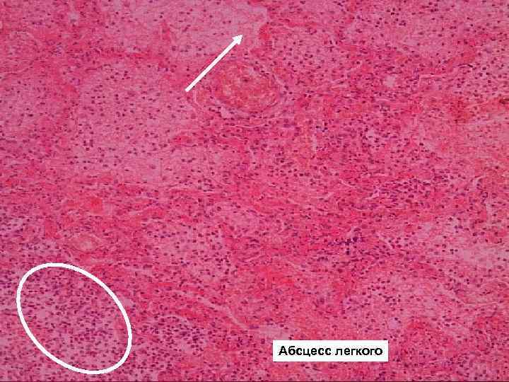 Абсцесс легкого 