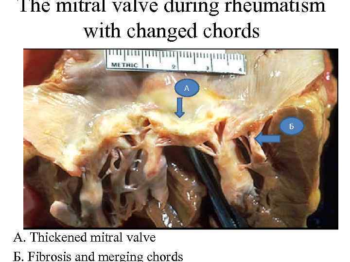 The mitral valve during rheumatism with changed chords А Б A. Thickened mitral valve