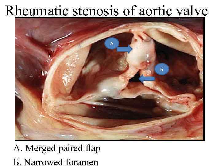 Rheumatic stenosis of aortic valve А Б A. Merged paired flap Б. Narrowed foramen