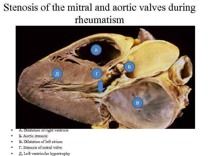 Stenosis of the mitral and aortic valves during rheumatism А Б Д Г В