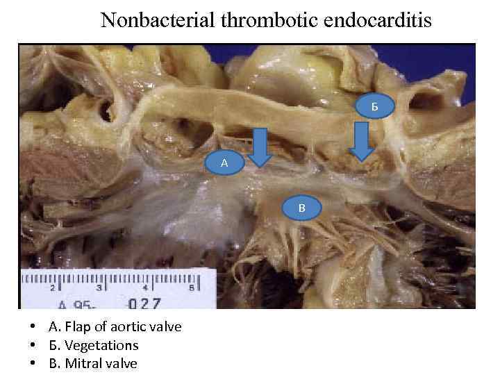 Nonbacterial thrombotic endocarditis Б А В • А. Flap of aortic valve • Б.