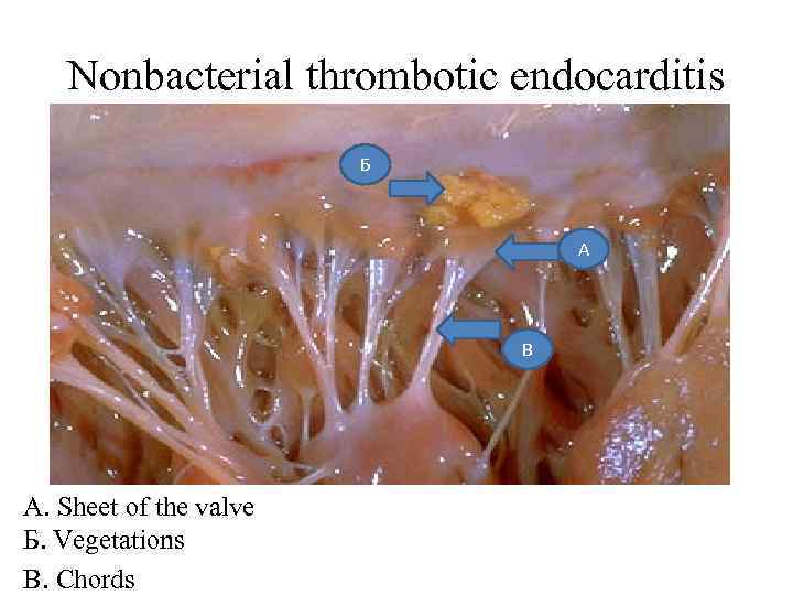 Nonbacterial thrombotic endocarditis Б А В А. Sheet of the valve Б. Vegetations В.