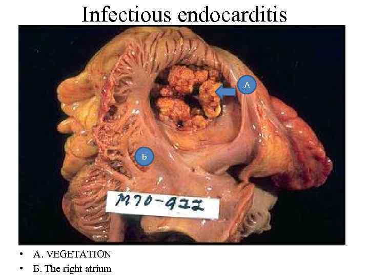 Infectious endocarditis А Б • A. VEGETATION • Б. The right atrium 