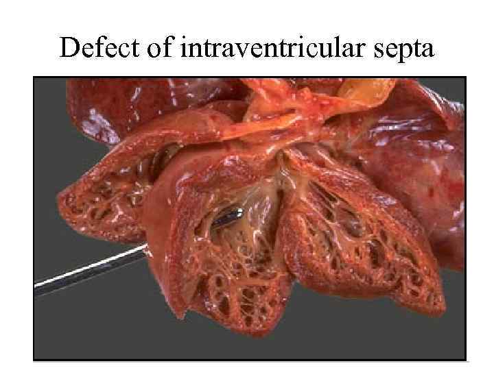 Defect of intraventricular septa 