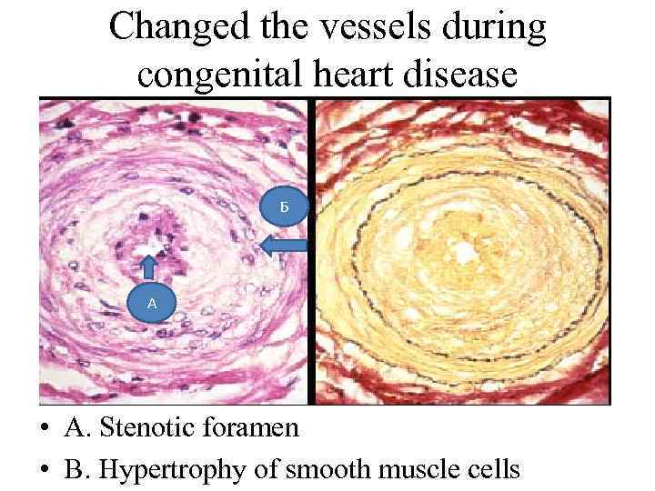 Changed the vessels during congenital heart disease Б А • A. Stenotic foramen •
