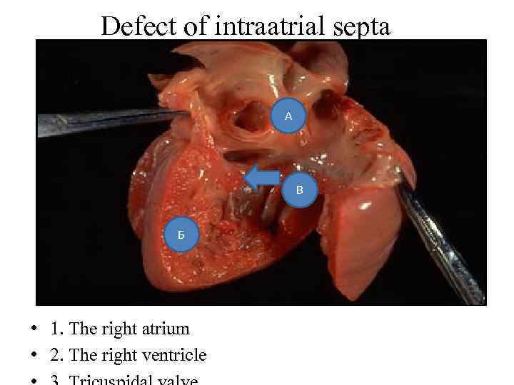 Defect of intraatrial septa А В Б • 1. The right atrium • 2.