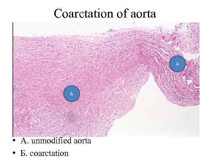 Coarctation of aorta А Б • A. unmodified aorta • Б. coarctation 