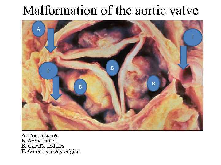 Malformation of the aortic valve А Г Б Г В А. Commissures Б. Aortic