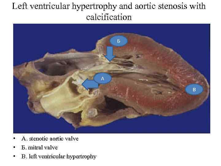 Left ventricular hypertrophy and aortic stenosis with calcification Б А В • A. stenotic