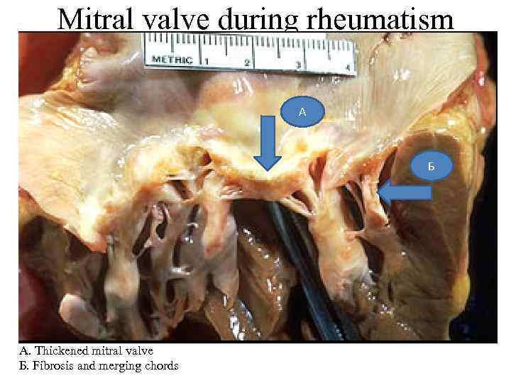 Mitral valve during rheumatism А Б A. Thickened mitral valve Б. Fibrosis and merging