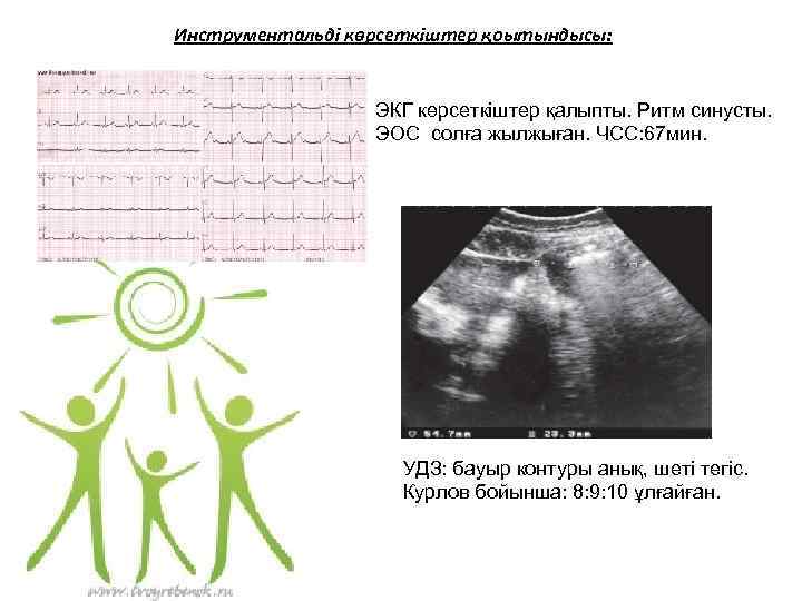 Инструментальді көрсеткіштер қоытындысы: ЭКГ көрсеткіштер қалыпты. Ритм синусты. ЭОС солға жылжыған. ЧСС: 67 мин.