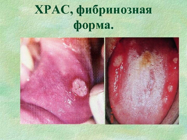 ХРАС, фибринозная форма. 
