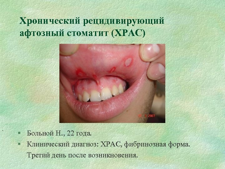 Хронический рецидивирующий афтозный стоматит (ХРАС) . § Больной Н. , 22 года. § Клинический