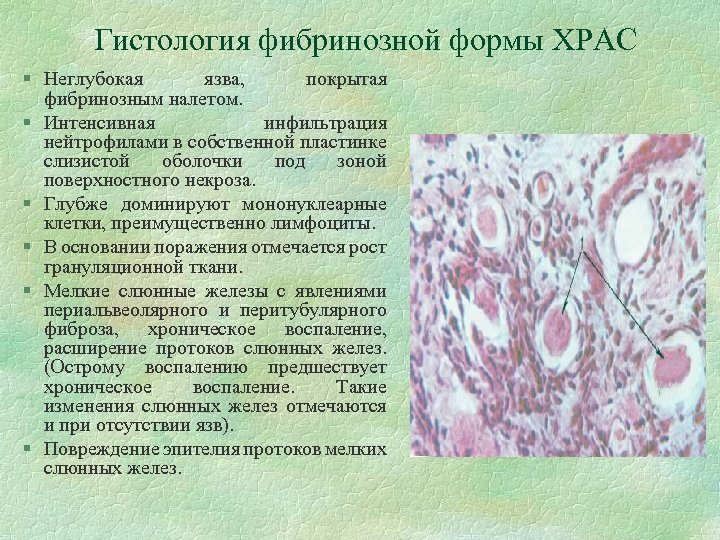 Гистология фибринозной формы ХРАС § Неглубокая язва, покрытая фибринозным налетом. § Интенсивная инфильтрация нейтрофилами