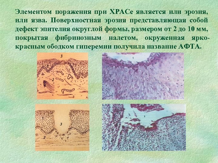 Элементом поражения при ХРАСе является или эрозия, или язва. Поверхностная эрозия представляющая собой дефект