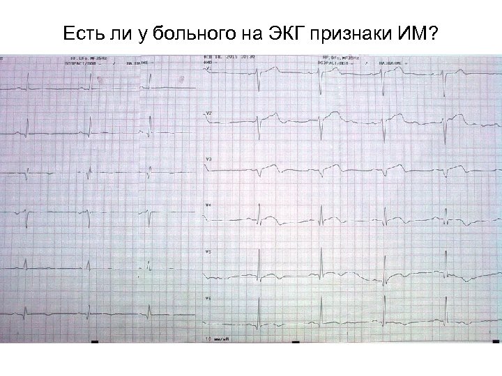 Есть ли у больного на ЭКГ признаки ИМ? 